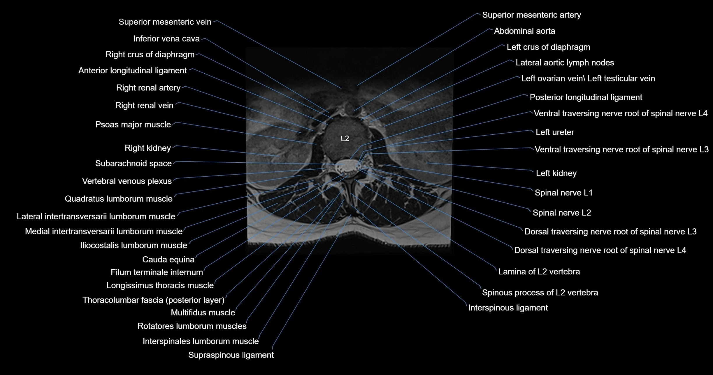 MRI lumbar spine axial cross sectional anatomy 3T radiology  image-img-00001-00016.webp